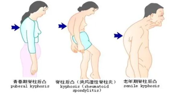 康复运动的目的_运动康复的意义_康复运动的重要性